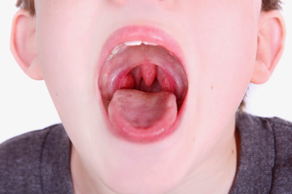 Những biến chứng viêm họng ở trẻ đi mẫu giáo có thể mắc